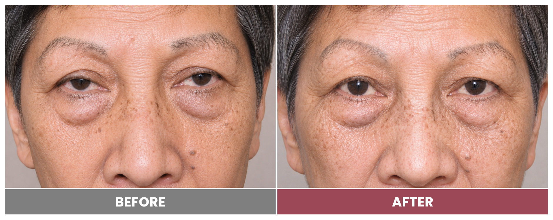 PTOSIS REPAIR - Case 73